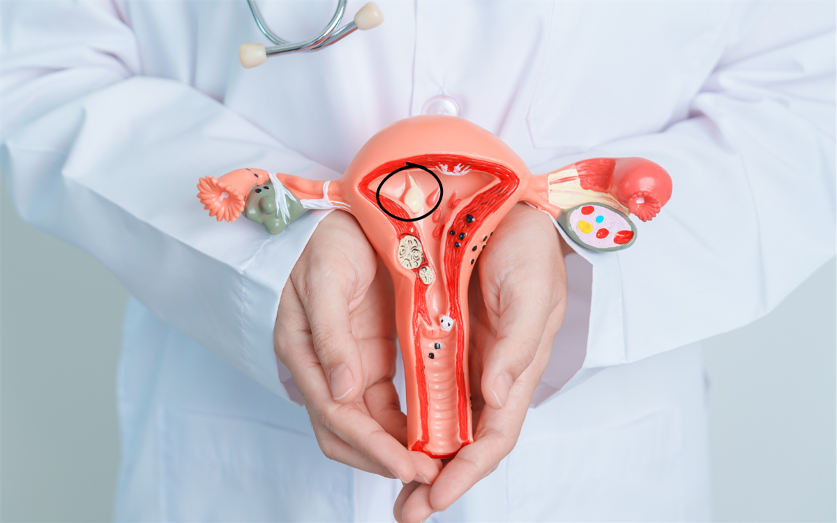 Endometrial Polip