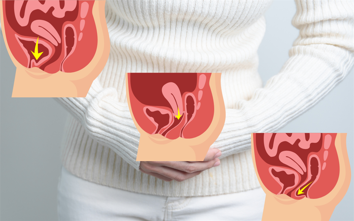 Genital Organ Sarkmaları ve Tedavisi
